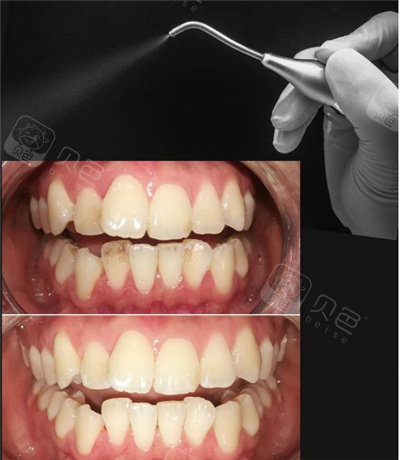 有人说厦门口腔医院洗牙好贵啊!但是对比效果你就知道差异!