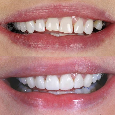 国产钴铬合金烤瓷牙冠1200元/颗;国产全瓷牙冠修复2300元/颗;参考价格