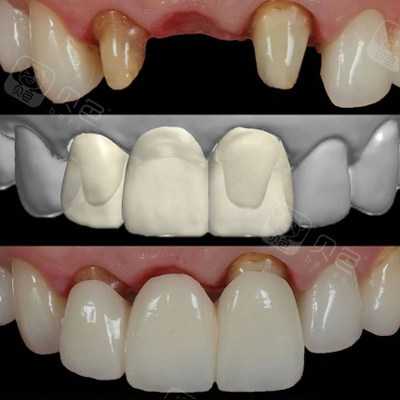 南通烤瓷牙修复价格是多少全瓷牙价格是不是更贵