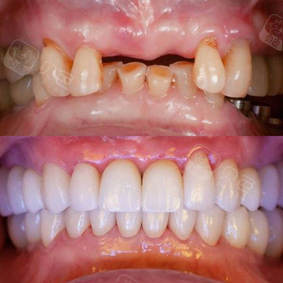 汇集多人种植牙经验分享~告诉你孝感种植牙哪家好!