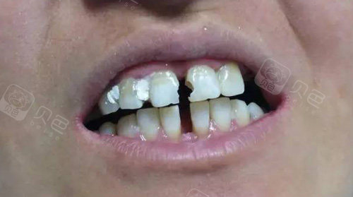 牙齿缝隙越大该怎么治疗