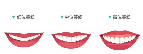 什么是牙齿微笑线 做牙齿校正时可以怎么调整微笑线 贝色口腔