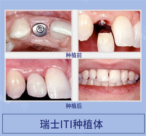 蚌埠三爱口腔瑞士iti种植体对比