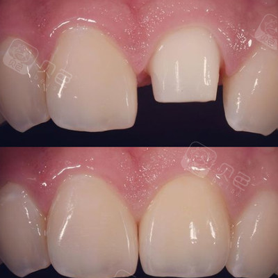 门牙全瓷冠修复