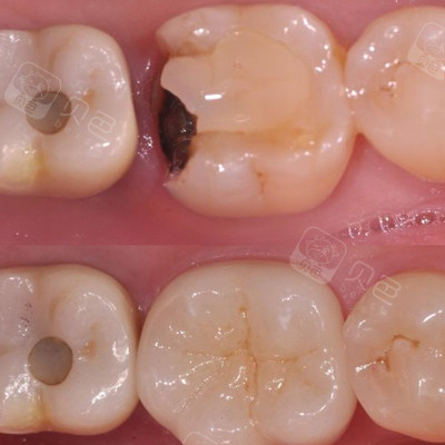 合肥镶牙哪里比较好?汇总性价比高的正规机构! - 贝色口腔