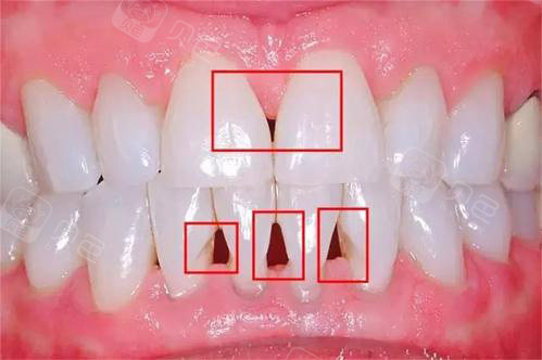 细数牙齿矫正的后遗症和危害分析牙齿矫正副作用的原因