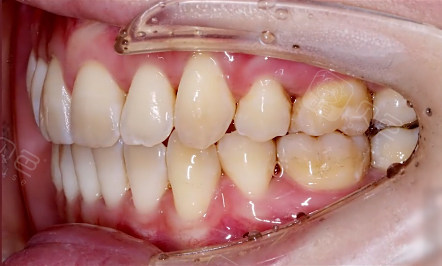 得了牙周炎病还能做牙齿矫正吗并非不能但需要注意这些