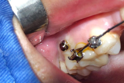 牙齿矫正什么情况下要打骨钉打骨钉疼吗具体有什么用