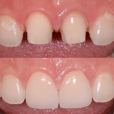 南京牙冠多少钱一颗?告诉你南京各品牌全瓷牙要多少钱!