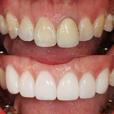 南京牙冠多少钱一颗?告诉你南京各品牌全瓷牙要多少钱!