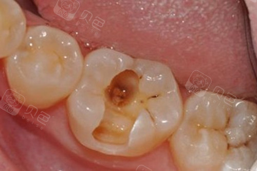 所以遇到口腔问题也不会及时跟家长说,导致后期对牙齿的损伤越来越大