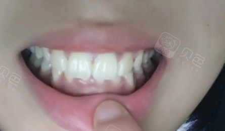 上牙盖住下牙怎么办如何治疗上海美奥做凸嘴效果好吗