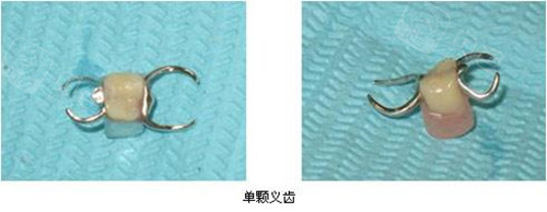 门牙掉了一颗种牙还是镶牙好?镶牙和种植牙的区别在哪里