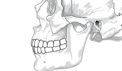 上牙盖住下牙怎么办如何治疗上海美奥做凸嘴效果好吗