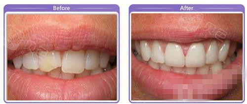 门牙磕掉了一小块怎么修复?可以把磕掉的一半再接回去吗?