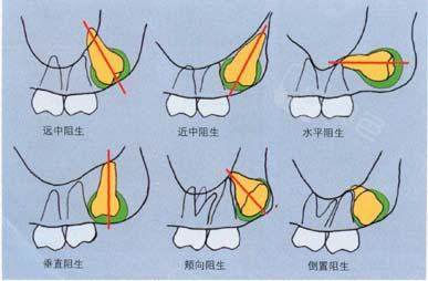 垂直中位智齿:399元/颗起;郑州拔智齿价格参考表:但是对于阻生智齿,还