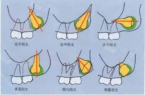 正位上颌智齿是268元起,下颌智齿468元起,阻生智齿865元起,分享几家