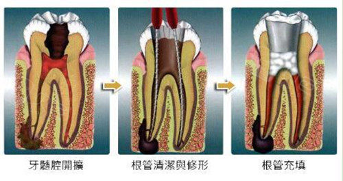 根管治疗过程图解