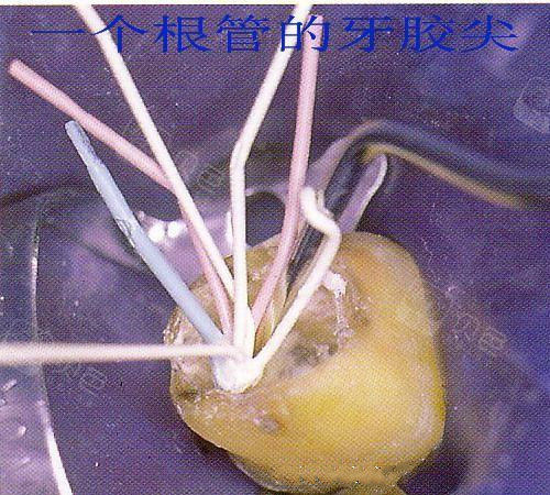 根管治疗后必须做牙套吗?杀牙神经坚决不戴牙冠是对是错? - 贝色口腔