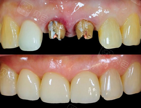 种植牙修复前后对比