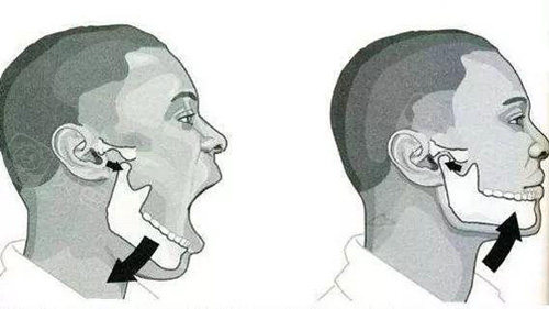 颞下颌关节弹响能做矫正吗 - 贝色口腔