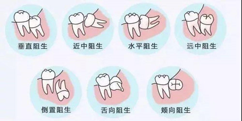 什么是阻生智齿?智齿阻生有几种类型?阻生智齿一定要拔吗?