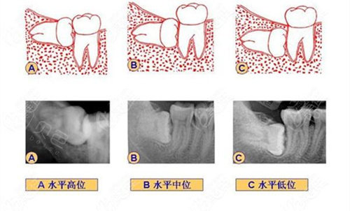 全部或者一部分无法正常萌出,就叫阻生智齿,也叫阻生牙