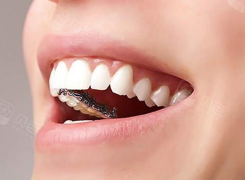 舌侧矫正的优缺点科普贴! - 贝色口腔