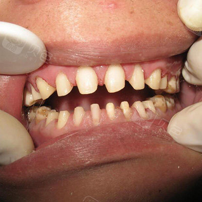 全瓷牙磨牙照片