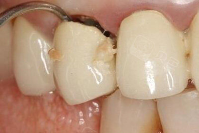 戴全瓷牙套的危害有哪些,听说全瓷牙套里的牙会烂是真的?