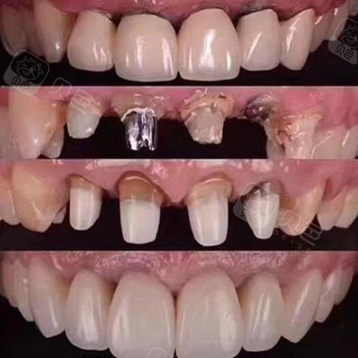 戴全瓷牙套的危害有哪些,听说全瓷牙套里的牙会烂是真的?