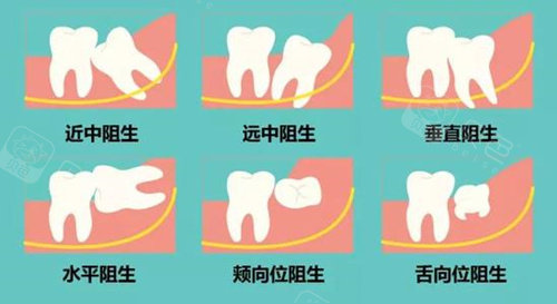 拔智齿前为什么要拍片烟台拔智齿哪个医院好