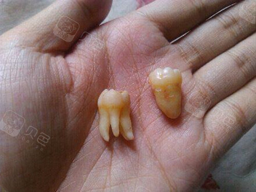 另外还有些智齿的牙根比较奇特,比较常见的有发散状,哑铃状,直角状等