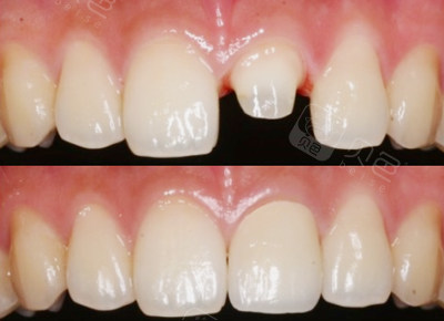 门牙全瓷牙修复