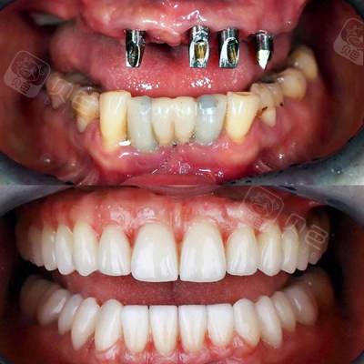 这几家正规牙科医院专注种植! - 贝色口腔