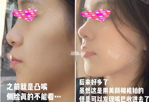 凸嘴千万别做牙齿矫正没有用?真人正畸前后对比图告诉你