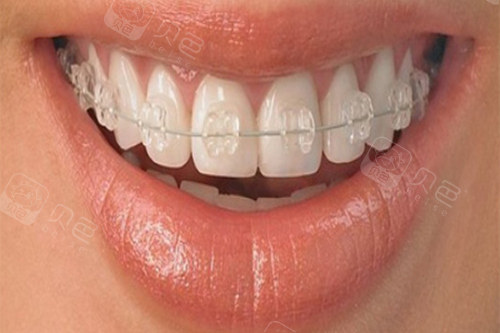 其实牙齿矫正方式主要分为四种:传统托槽矫正,舌侧矫正,半隐形矫正和