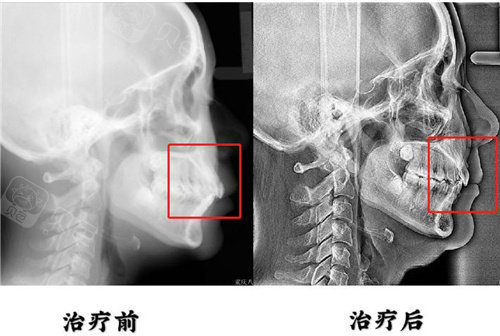 武汉凸嘴手术好的医院都是哪几家?这3家非常擅长骨性凸嘴 - 贝色口腔