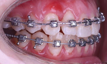 自锁金属托槽矫正器佩戴