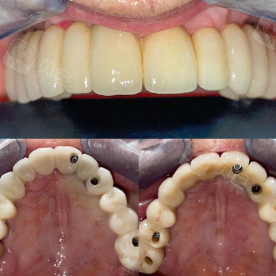 杭州全口种植牙价格是多少?带你了解杭州全口牙种植费用! - 贝色口腔