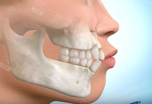 龅牙的牙齿图片