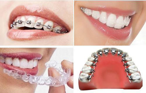 14岁整牙拔牙4颗有危害吗拔牙后带钢牙套会不会疼