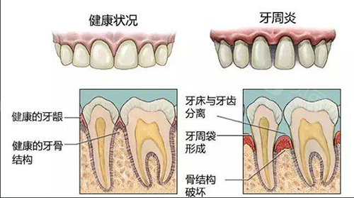 健康牙齿和牙周炎对比图