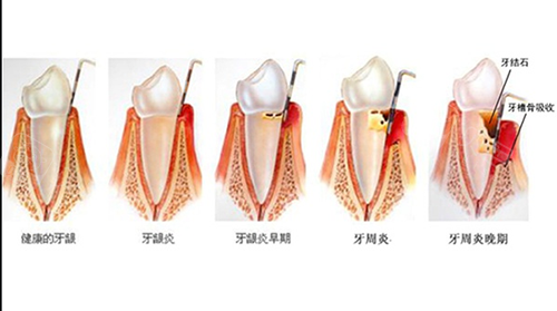 牙周炎的发病趋势图