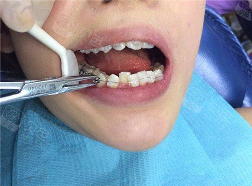 国产隐形牙套价格参考