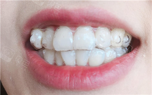 进口隐形牙套 span style=