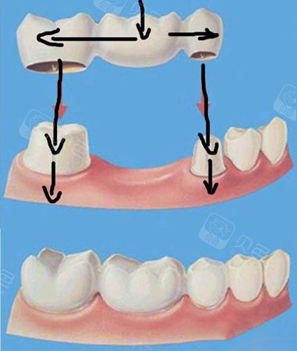 烤瓷桥修复图示