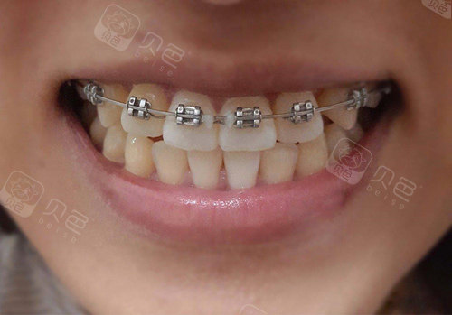 金属托槽半口矫正