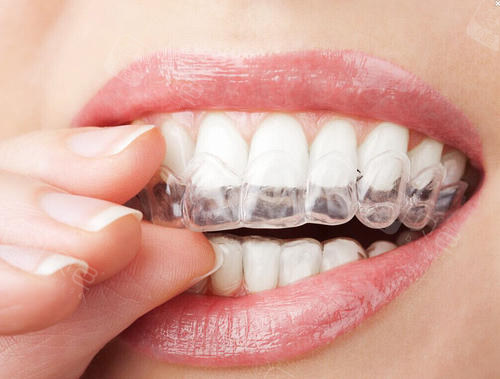 隐形牙套半口正畸