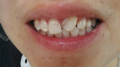 一颗门牙歪了可以单独矫正吗一个门牙歪了要怎么纠正